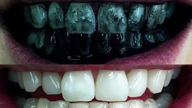 Teeth whitening with activated charcoal